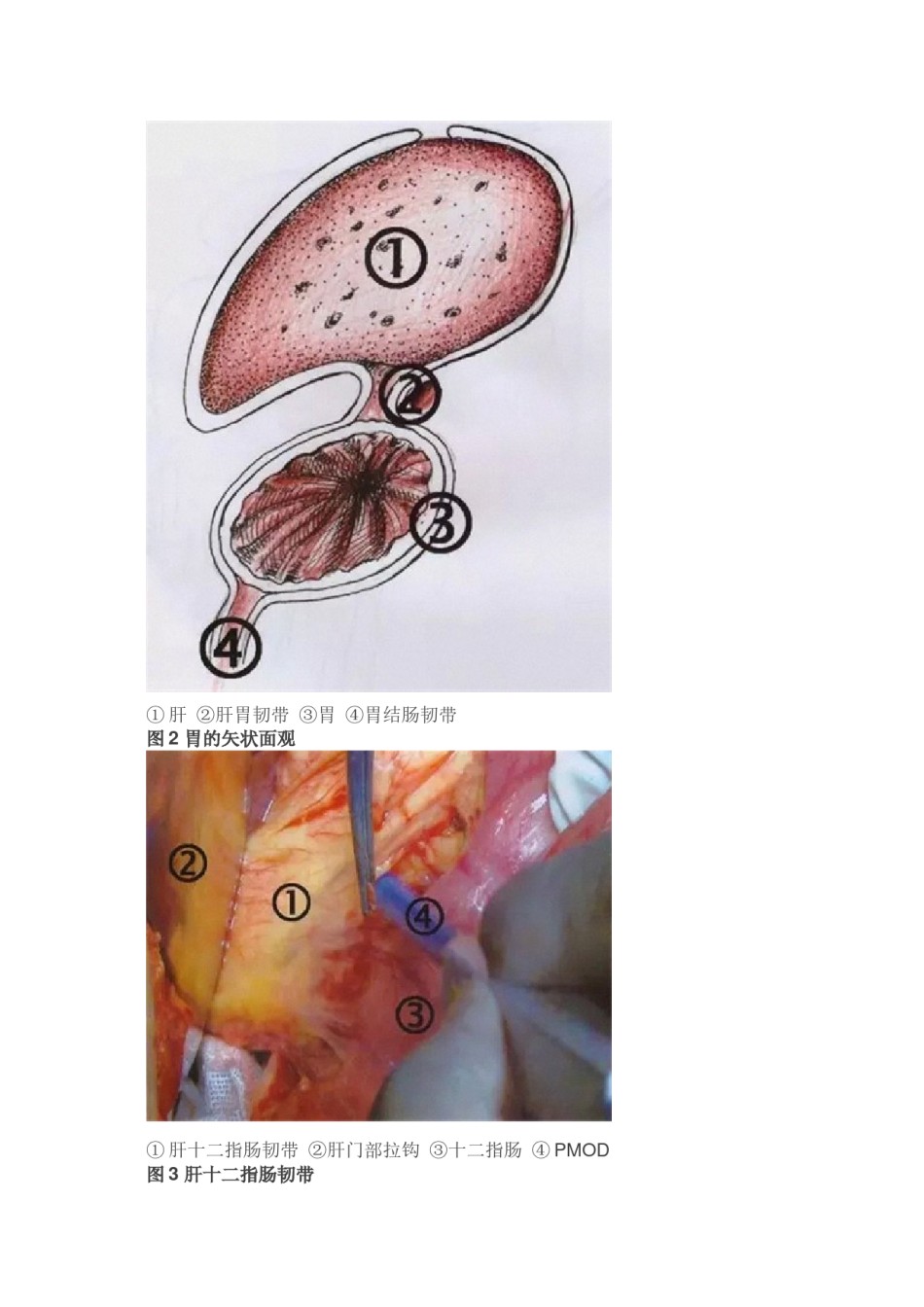 2022年医学专题—【手术图解】胃癌根治术(一)：胃的毗邻和腹膜.docx_第3页