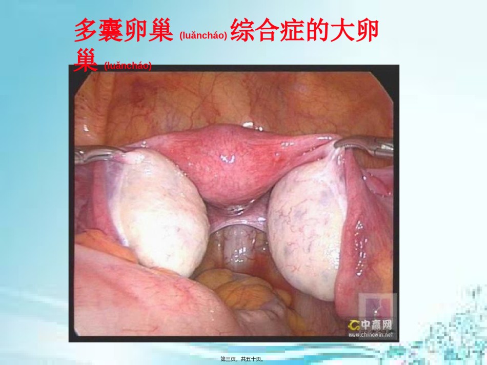 2022年医学专题—、多囊卵巢综合症(PCOS).ppt_第3页