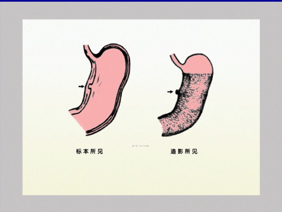 2022年医学专题—、胃肠道异常X-线表现.ppt_第2页