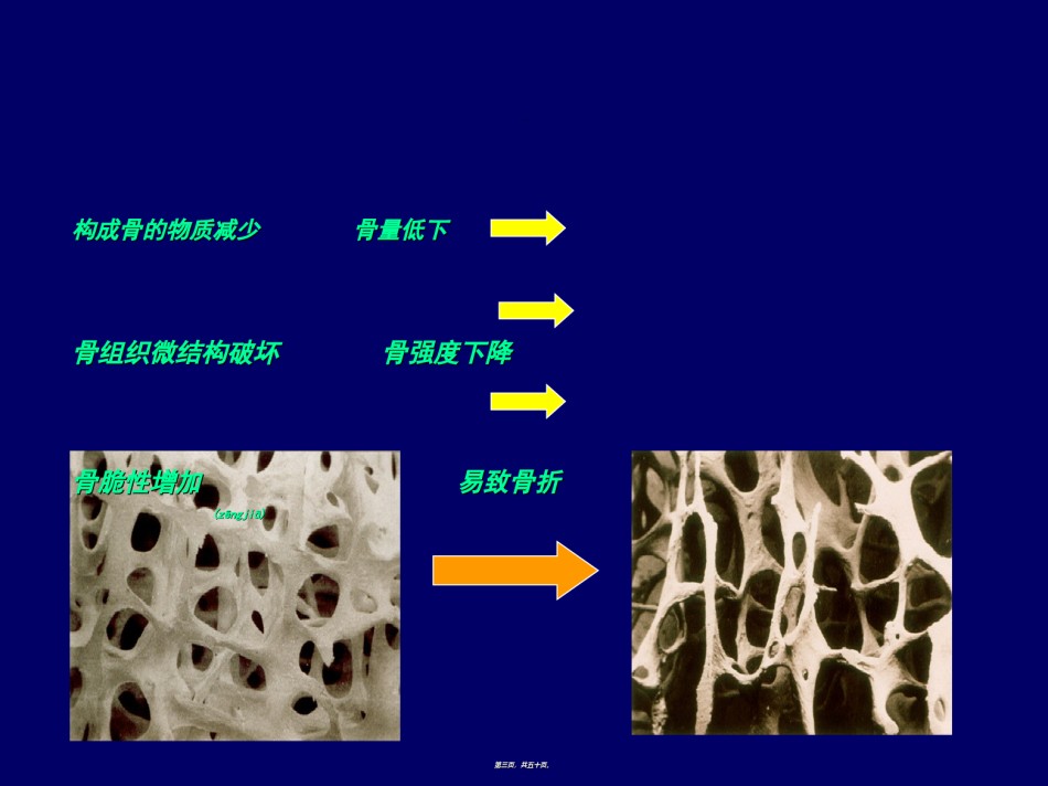2022年医学专题—.内分泌-2.骨质疏松症.ppt_第3页