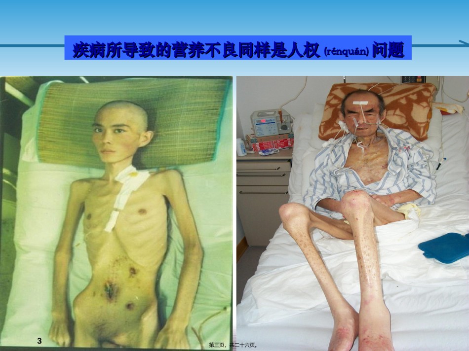 2022年医学专题—.肠内营养的实施与监测-王红民.ppt_第3页