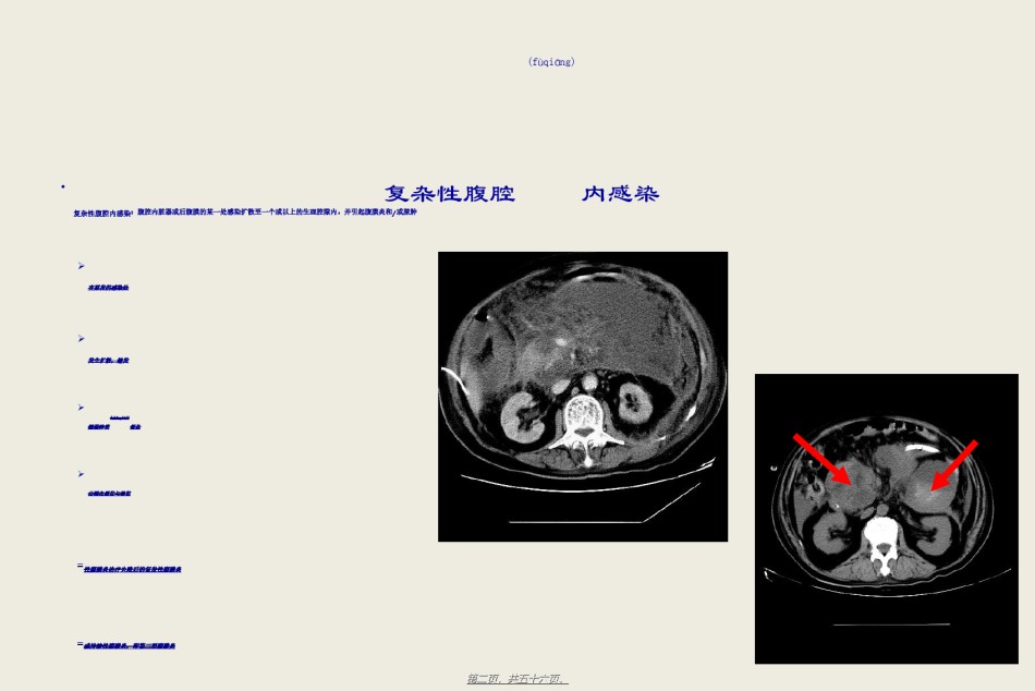 2022年医学专题—.复杂性腹腔感染的处理-毛恩强.ppt_第2页
