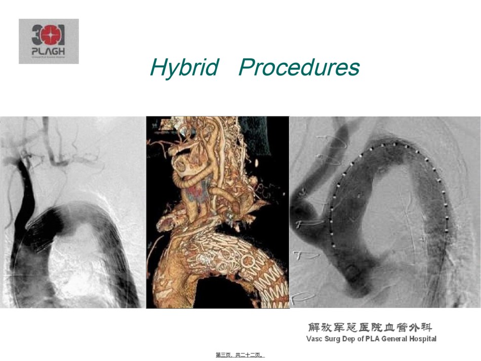2022年医学专题—[精品]主动脉弓复杂病变--HybridChmneyorelse.ppt_第3页