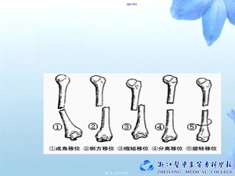 2022年医学专题—4胫腓骨干骨折.ppt_第2页