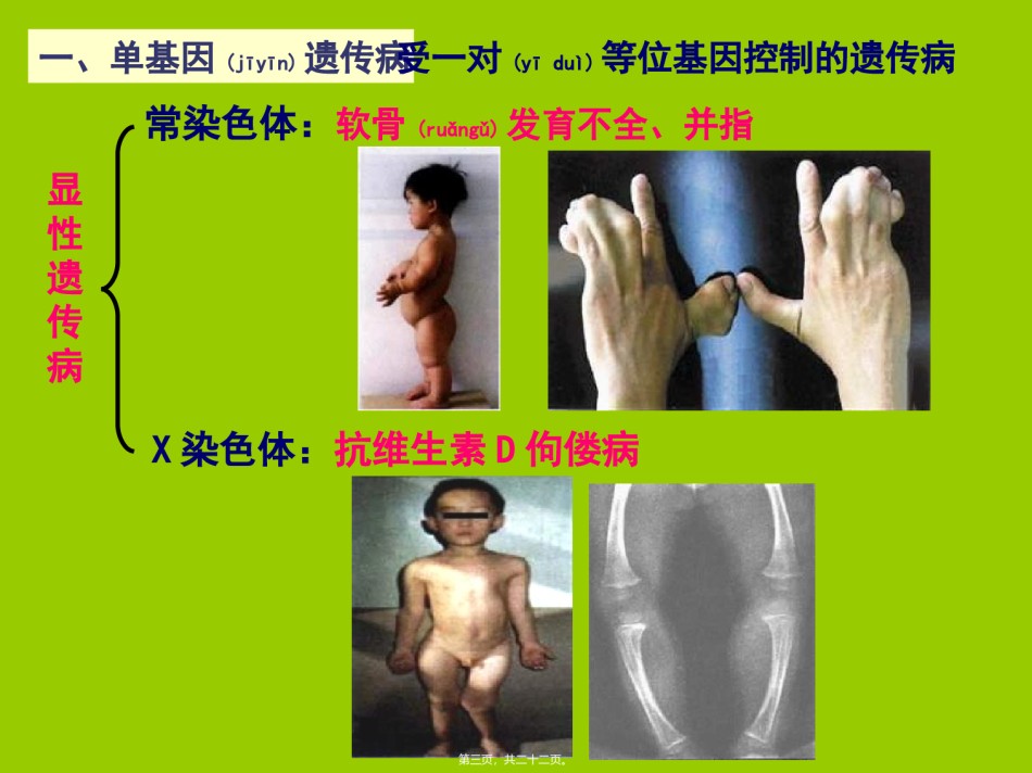 2022年医学专题—5.3--人类遗传病与优生.ppt_第3页