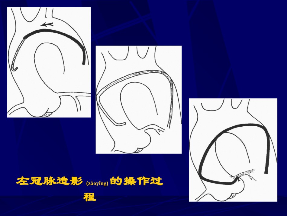 2022年医学专题—爱爱医资源-冠脉造影术简装板-绝好资料.ppt_第2页