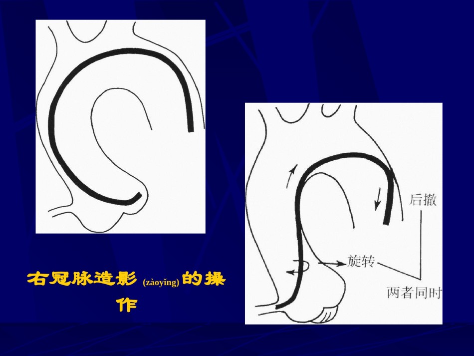 2022年医学专题—爱爱医资源-冠脉造影术简装板-绝好资料.ppt_第3页
