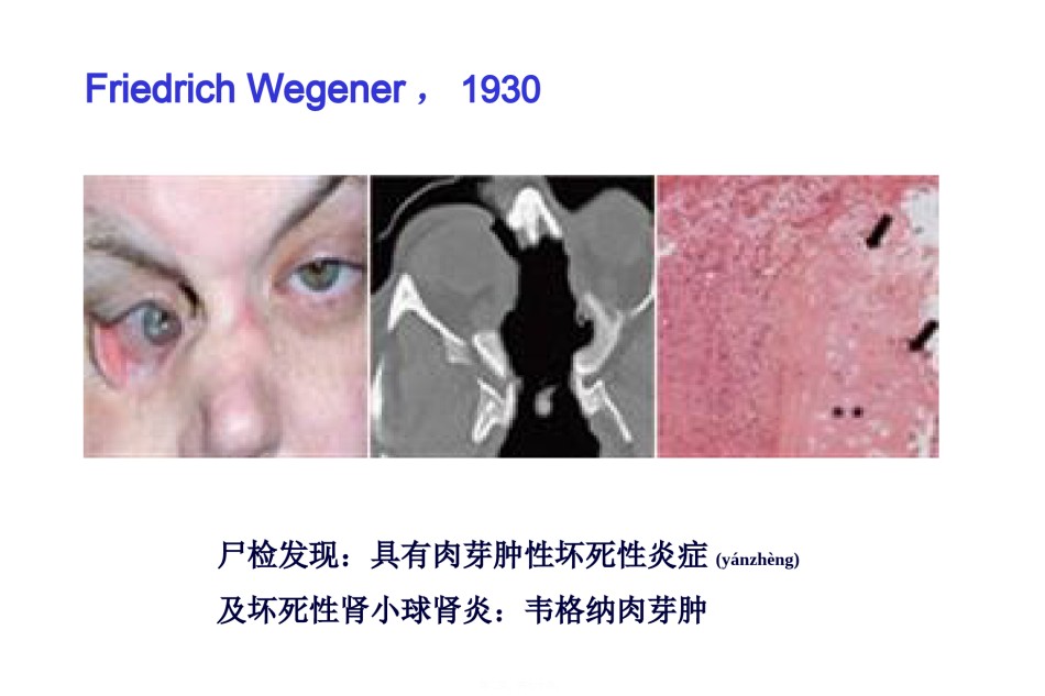 2022年医学专题—爱爱医资源-系统性血管炎2013.ppt_第2页