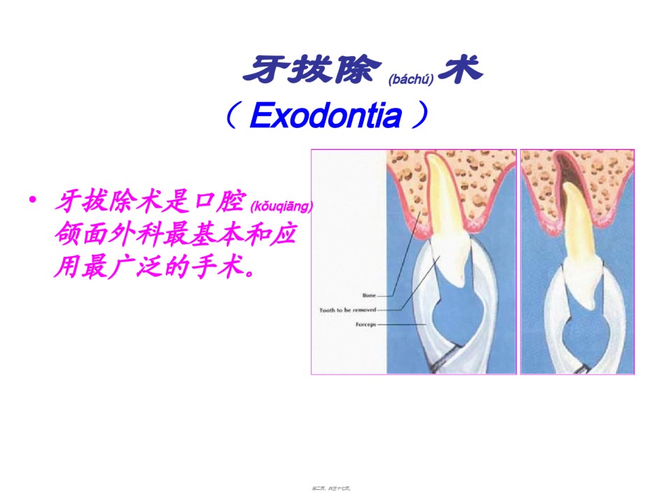 2022年医学专题—拔牙术2014.9.17.ppt_第2页