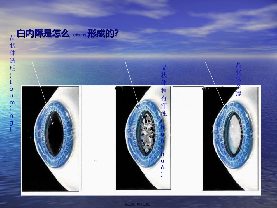 2022年医学专题—白内障-玻璃体混浊.ppt_第3页