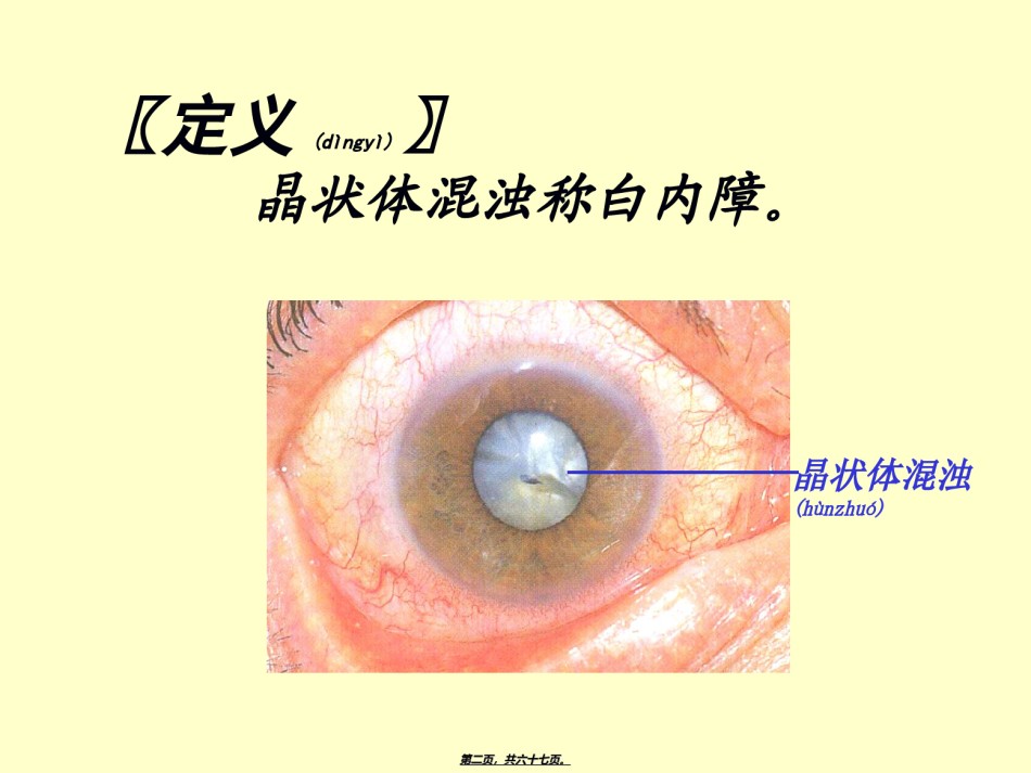 2022年医学专题—白内障(2).ppt_第2页