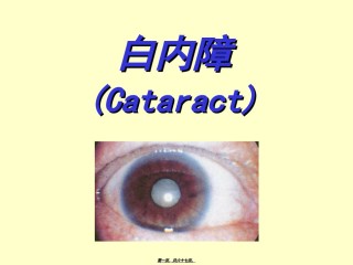 2022年医学专题—白内障(2).ppt