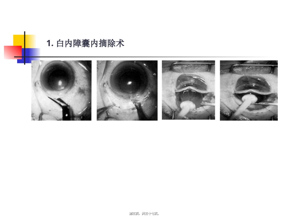 2022年医学专题—白内障超声乳化吸出进展.ppt_第3页