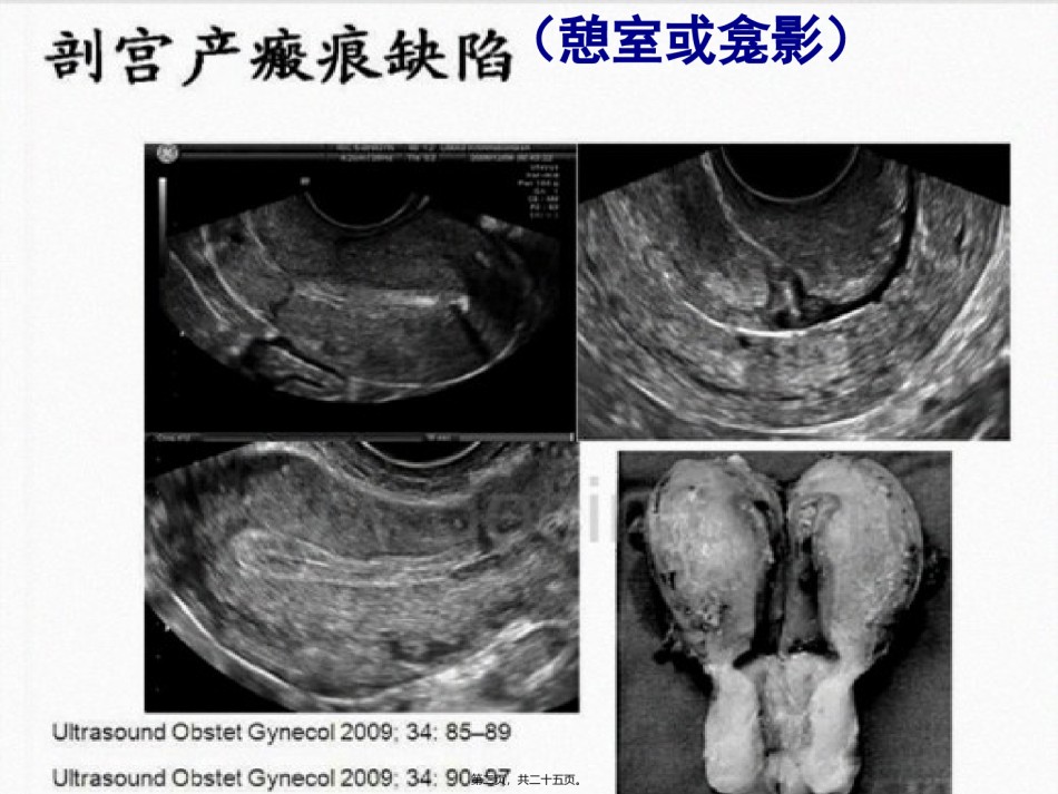 2022年医学专题—瘢痕妊娠1.ppt_第2页