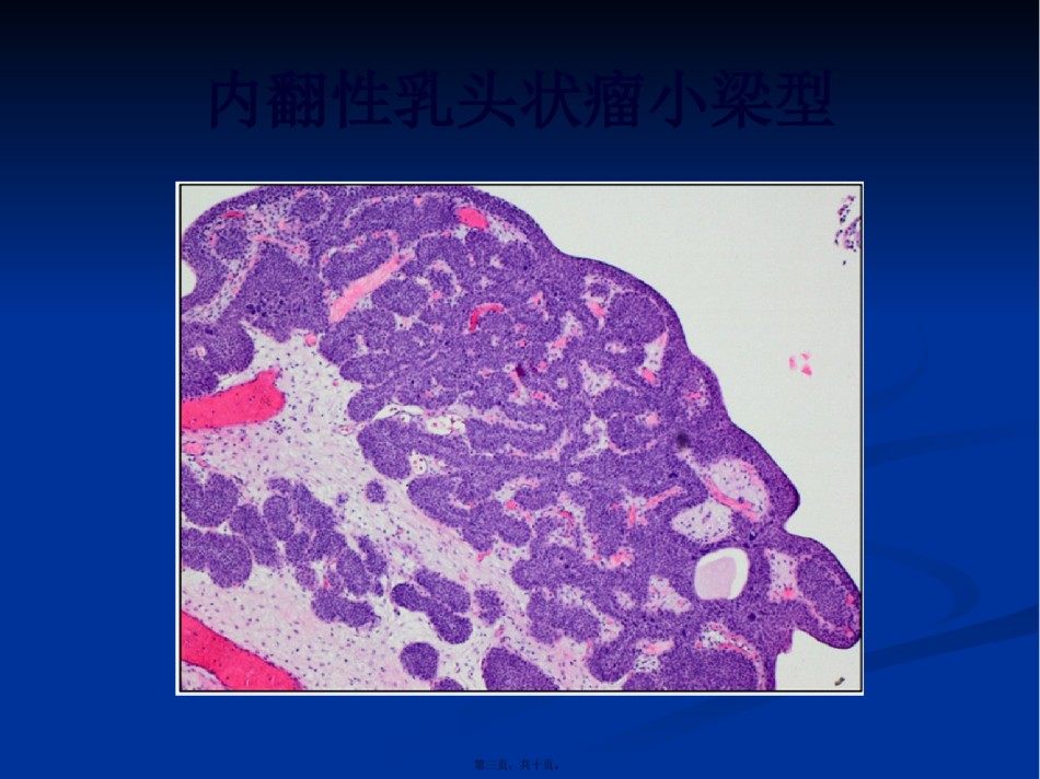 2022年医学专题—膀胱内翻性乳头状瘤.pptx_第3页