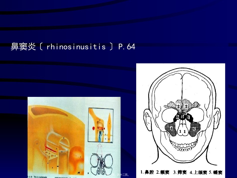 2022年医学专题—鼻窦炎.ppt_第1页
