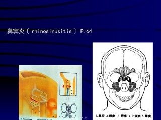 2022年医学专题—鼻窦炎.ppt