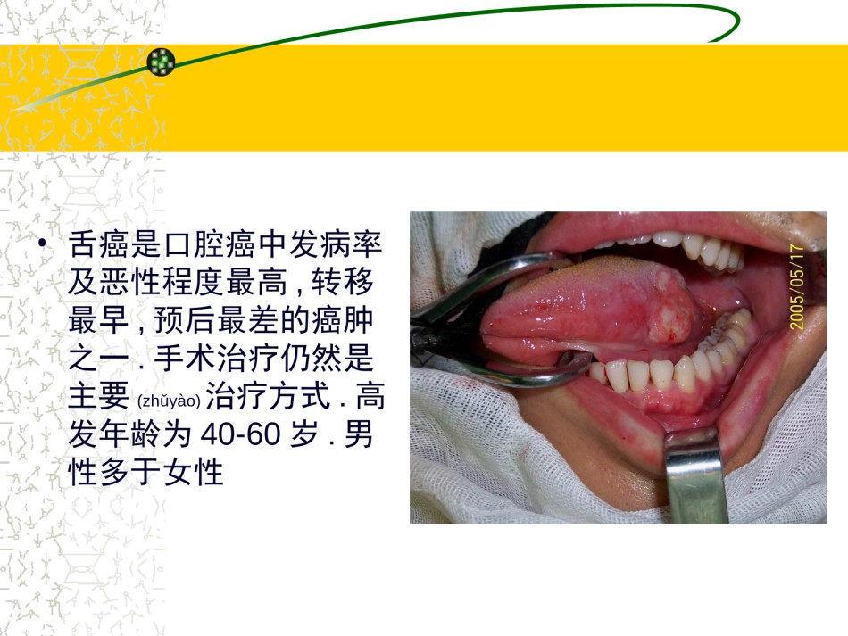 2022年医学专题—常见三种舌癌手术方式1.ppt_第3页