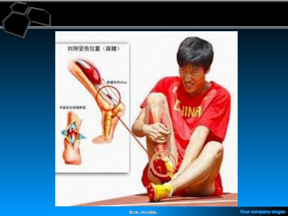 2022年医学专题—常见运动伤病的自我处理.ppt_第2页