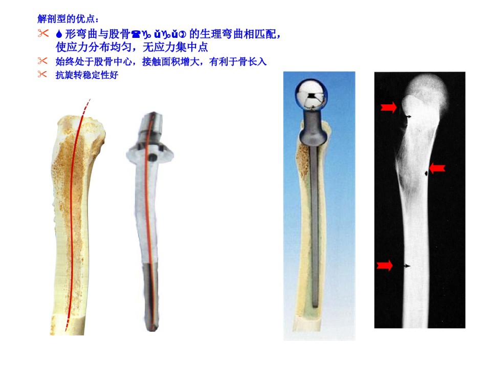2022年医学专题—常用髋关节假体类.ppt_第3页