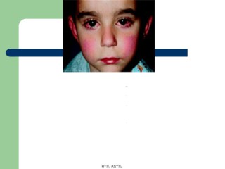 2022年医学专题—川崎病.ppt分析.ppt