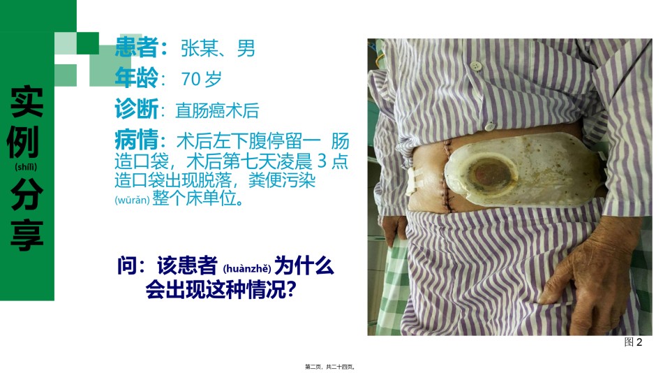 2022年医学专题—肠造口袋更换.pptx_第2页
