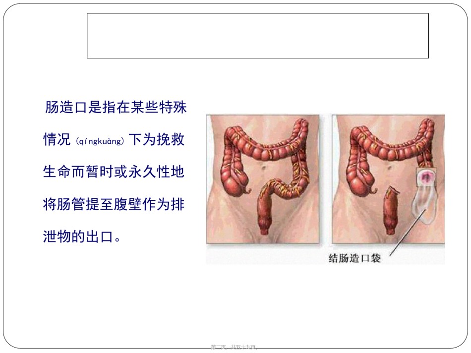 2022年医学专题—肠造口术.ppt_第2页