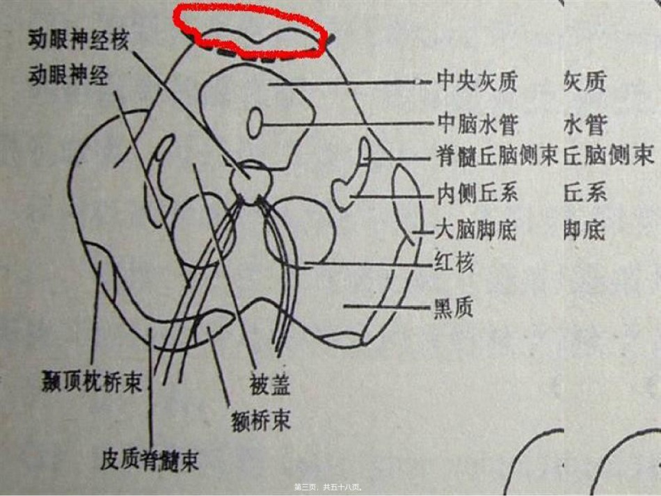 2022年医学专题—常见的脑干损害综合征-迷宫中的+迷宫.ppt_第3页