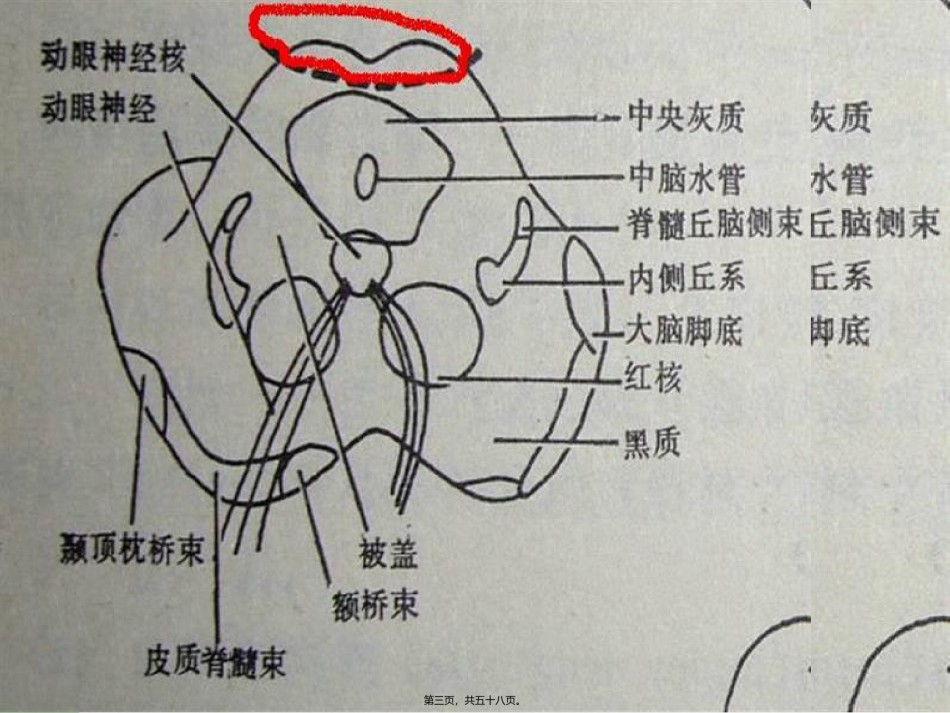 2022年医学专题—常见的脑干损害综合征模板.ppt_第3页