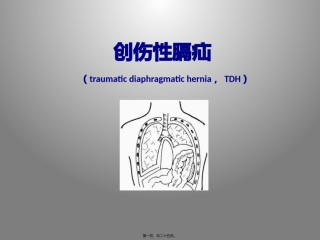 2022年医学专题—创伤性膈疝.pptx