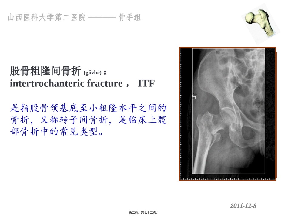 2022年医学专题—粗隆间骨折--cz.ppt_第2页