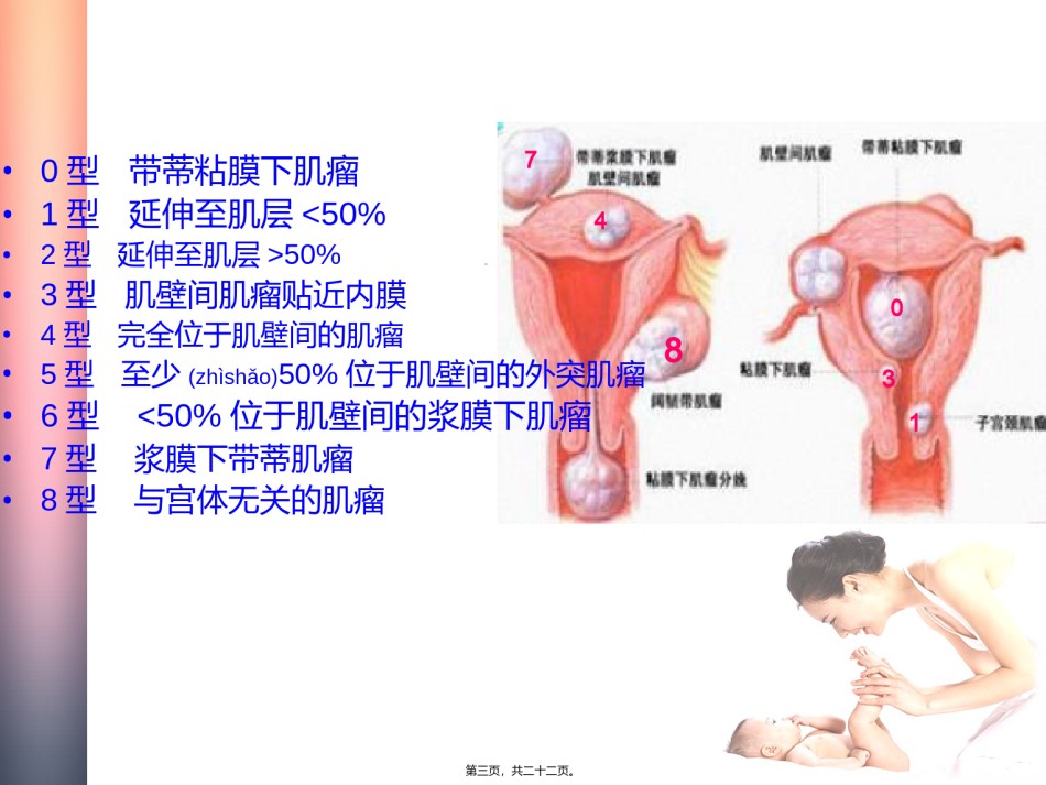 2022年医学专题—不孕妇女子宫肌瘤的处理策略.ppt_第3页