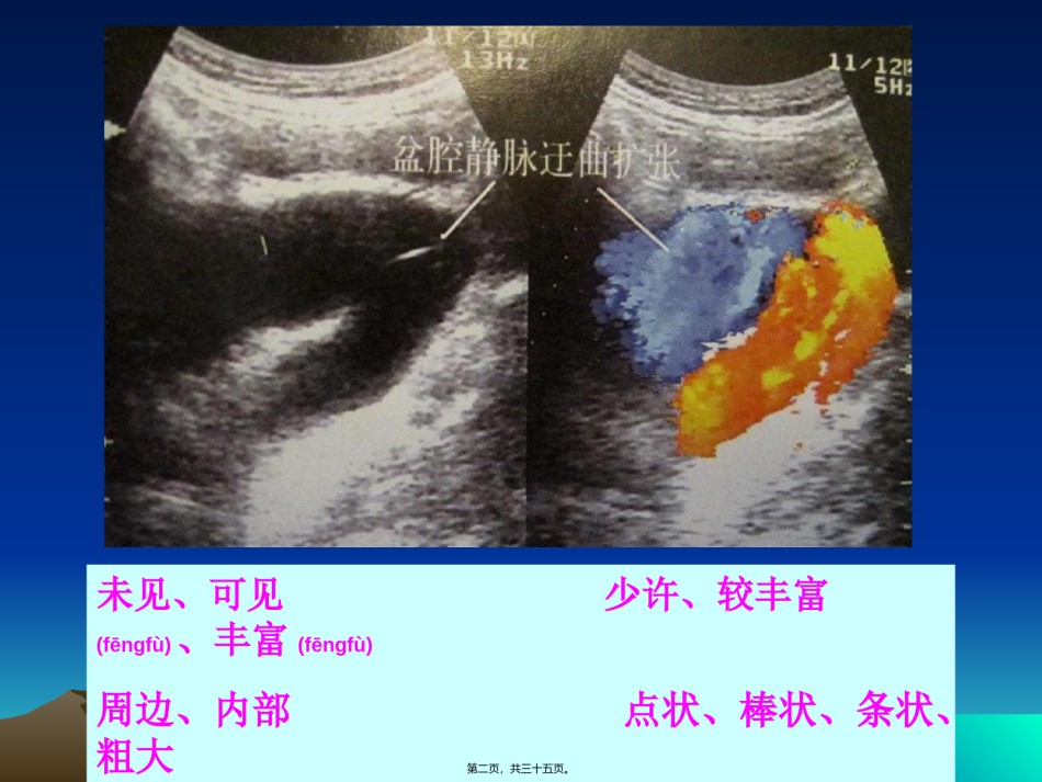 2022年医学专题—彩超在妇科方面的运用.ppt_第2页