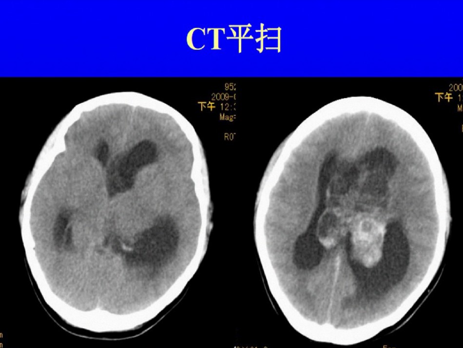 2022年医学专题—侧脑室中枢神经细胞瘤.ppt_第3页