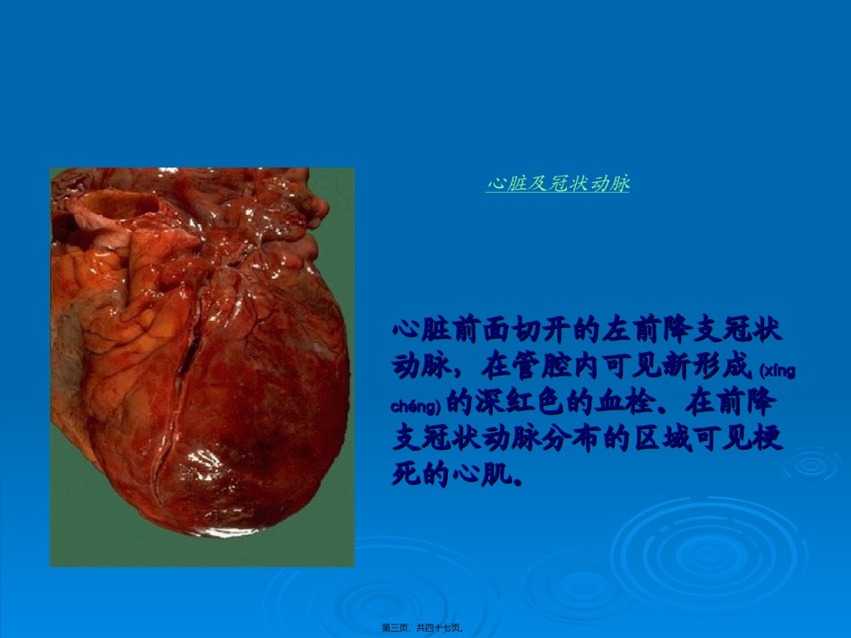 2022年医学专题—层螺旋CT冠脉成像.ppt_第3页