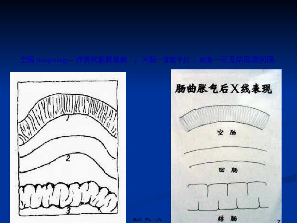 2022年医学专题—肠梗阻的分类及影像学表现分析.ppt_第3页