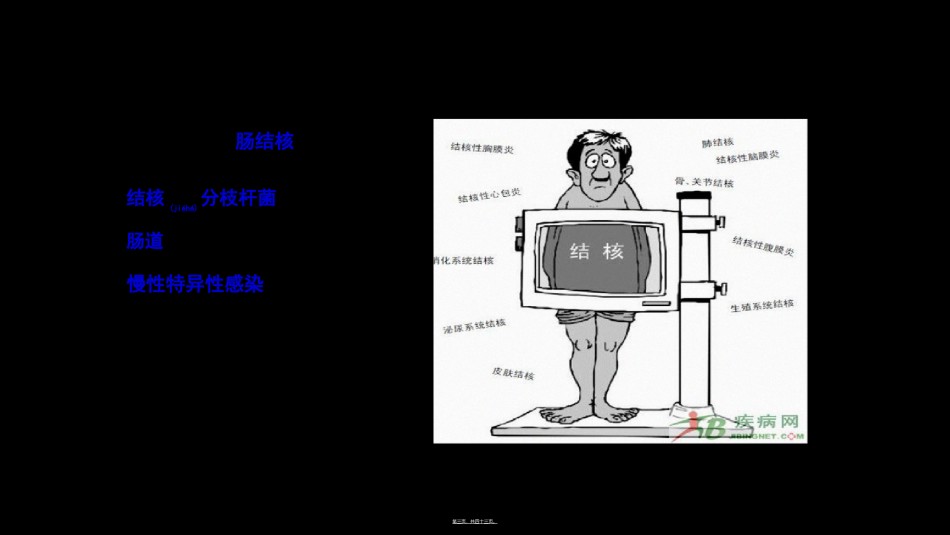 2022年医学专题—肠结核结核性腹膜炎.ppt_第3页