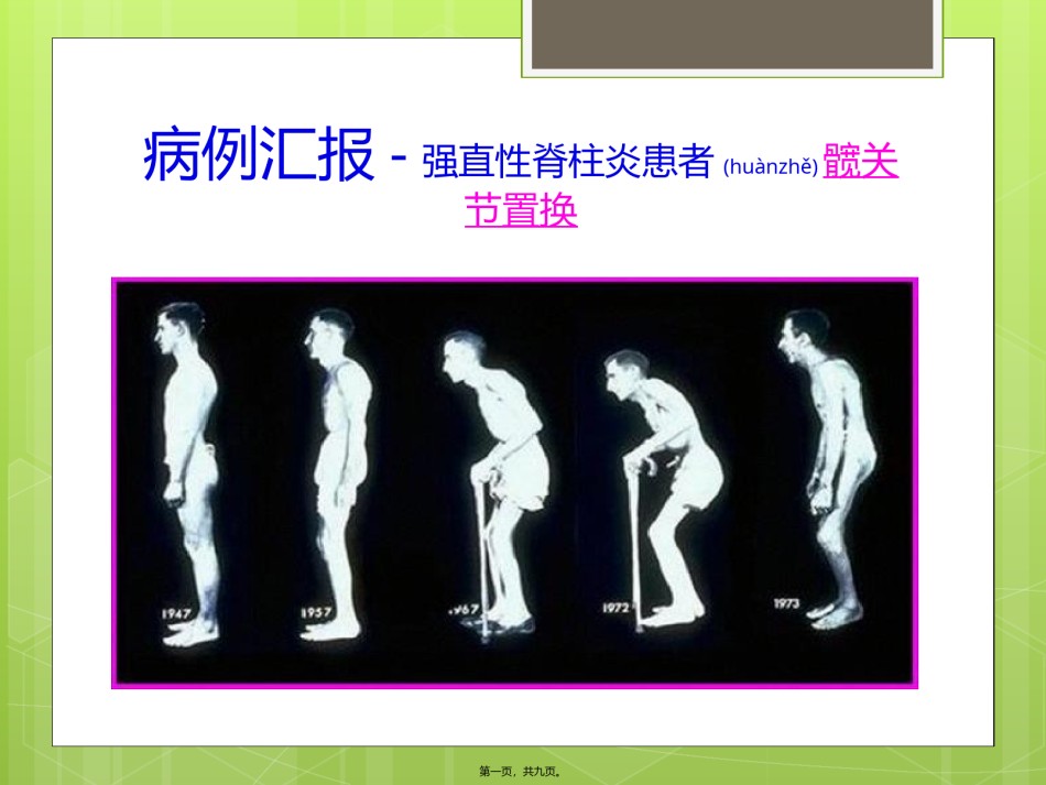 2022年医学专题—病例分析—强直性脊柱炎.pptx_第1页