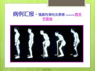 2022年医学专题—病例分析—强直性脊柱炎.pptx