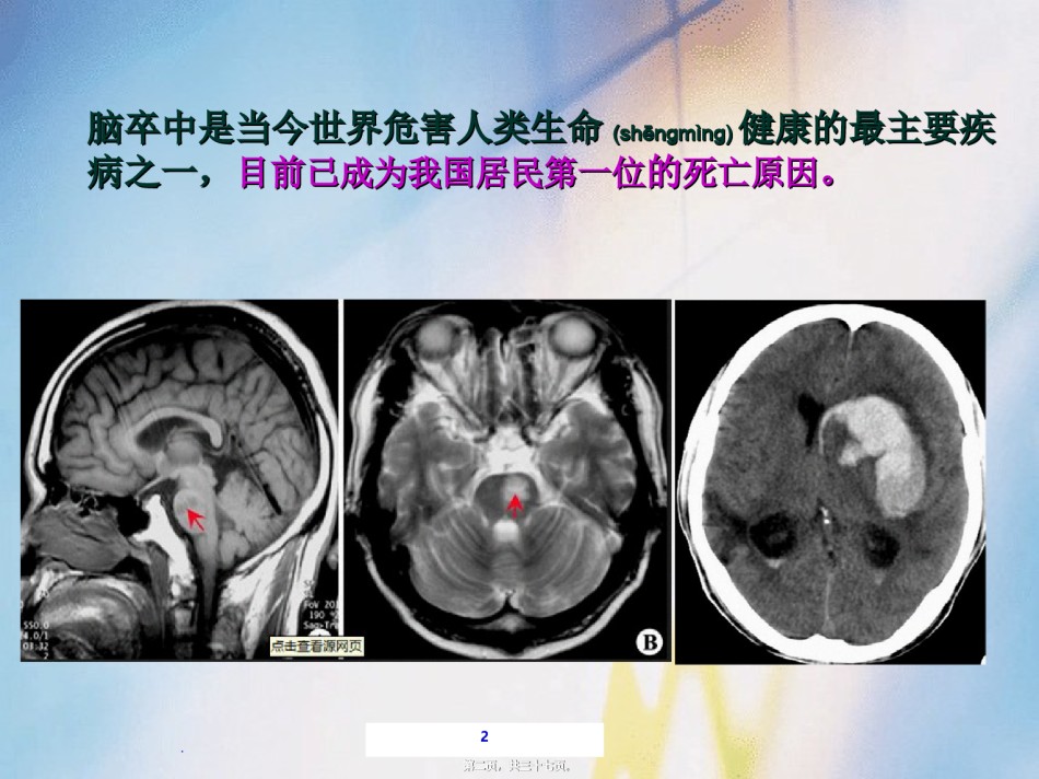 2022年医学专题—病例分享——卒中相关性肺炎2.ppt_第2页