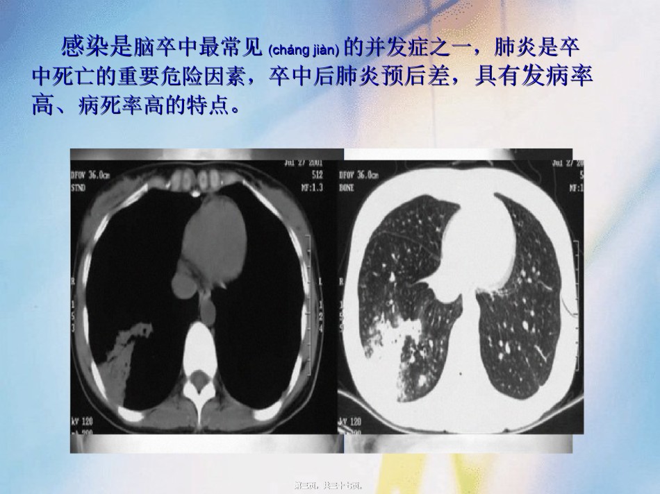 2022年医学专题—病例分享——卒中相关性肺炎2.ppt_第3页